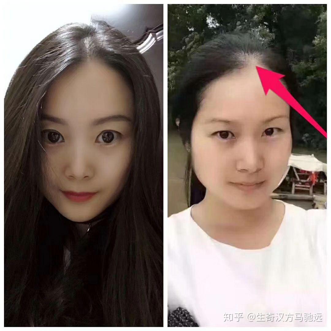 发际线一直往后退怎么办? 