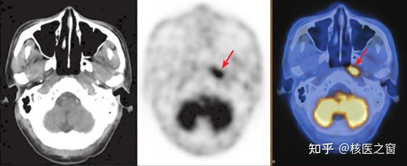 18f-fdg pet未见高代谢病灶,随访1年未见肿瘤复发鼻咽癌治疗后明确有