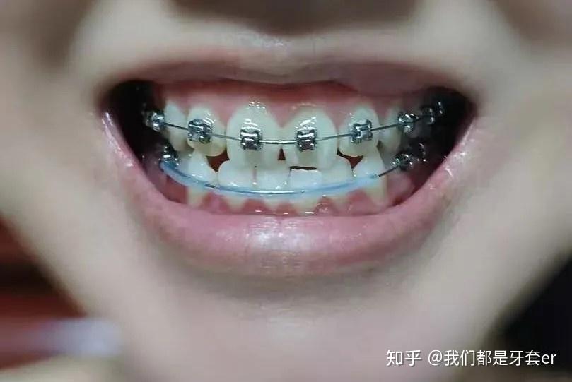 案例分享地包天前牙对刃颌没拔牙只做了片切戴牙套后从圆脸变成了长脸