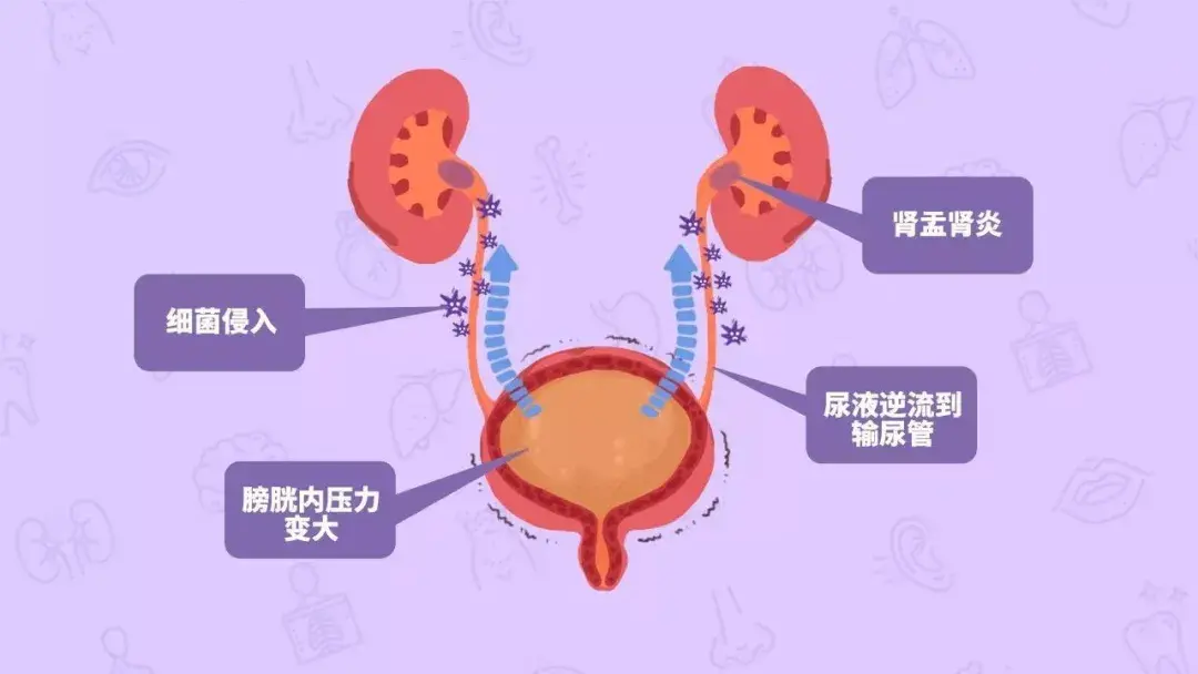 下泌尿道,尿路感染根据感染部位不同可分为肾盂肾炎,膀胱炎,尿道炎和