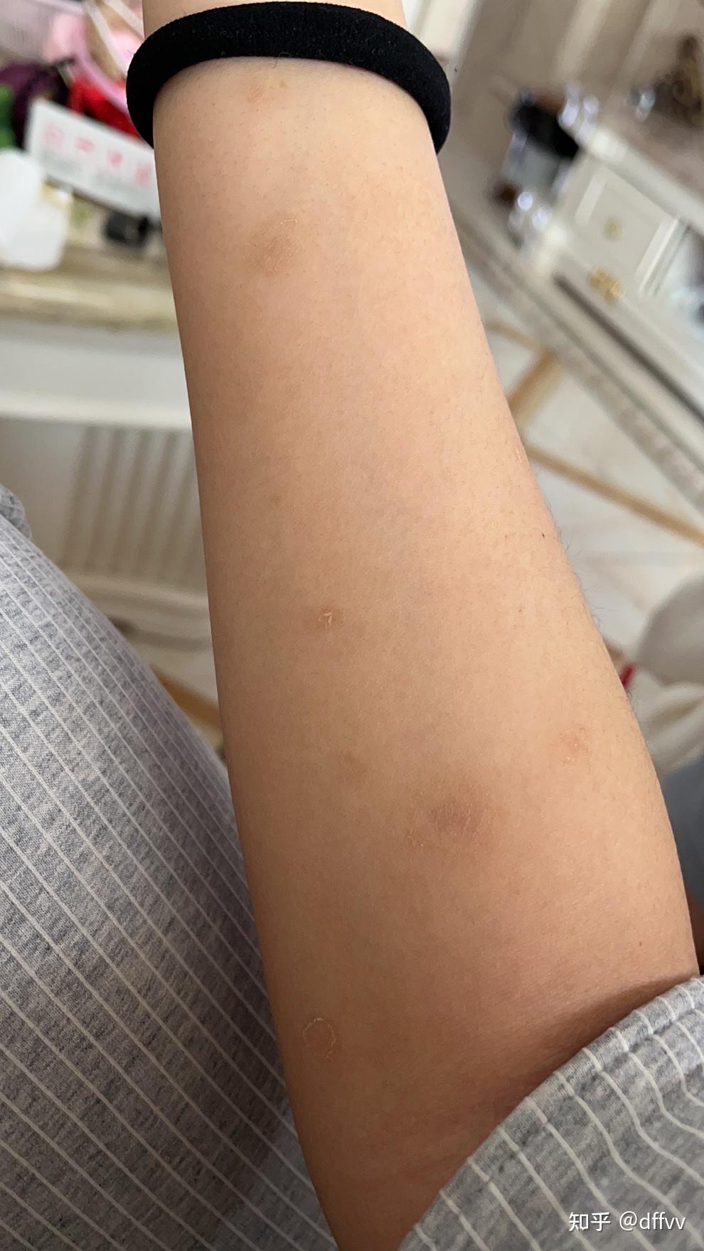 玫瑰糠疹治疗记录