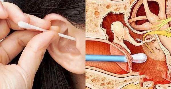 求你别掏耳屎肿瘤颅内感染失聪这些潜在危险你永远不知道