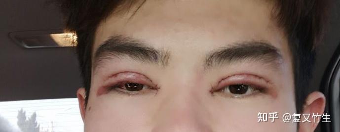 上睑提肌 全切双眼皮 开内眼角手术恢复记录 - 知乎