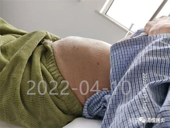 细胞回输后28天,腹部平坦了许多,胸腹水早就不需要引流这例受试者car