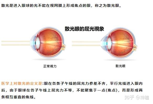 近视与散光都是眼睛的一种屈光不正的表现