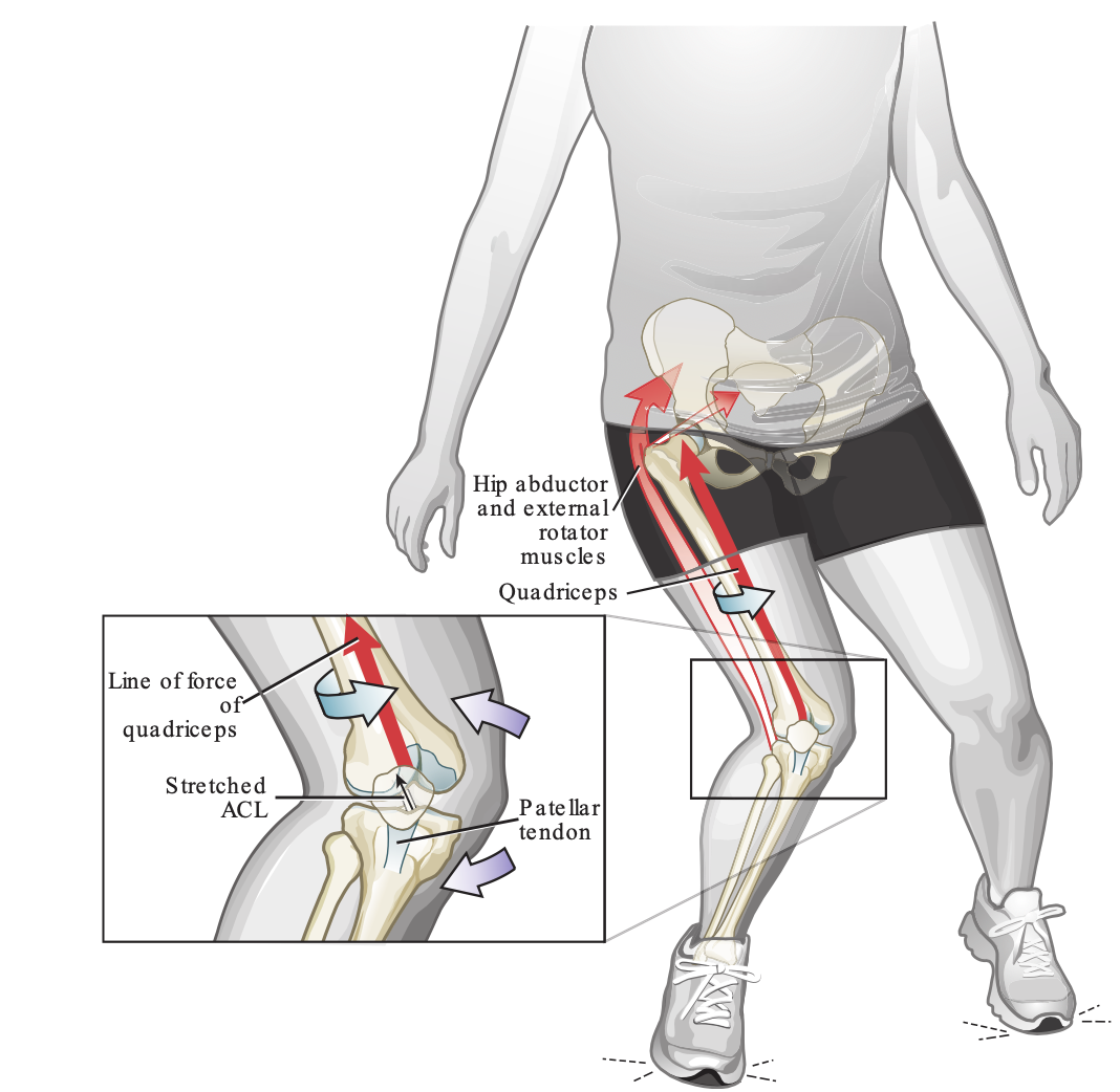 髌骨外移是如何产生的?
