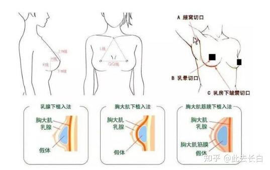 各年龄段女性如何选择适合的隆胸假体材料呢