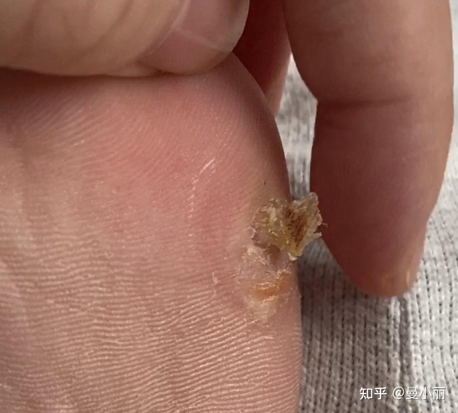 酷刑之冷冻跖疣