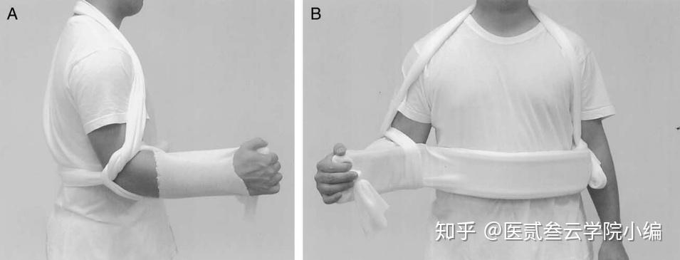 肩关节外旋位固定的两种方法