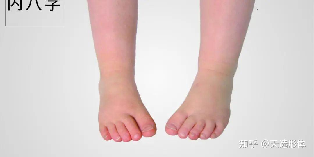 16岁女生走路内八字被群嘲别错过孩子双腿矫正的黄金期
