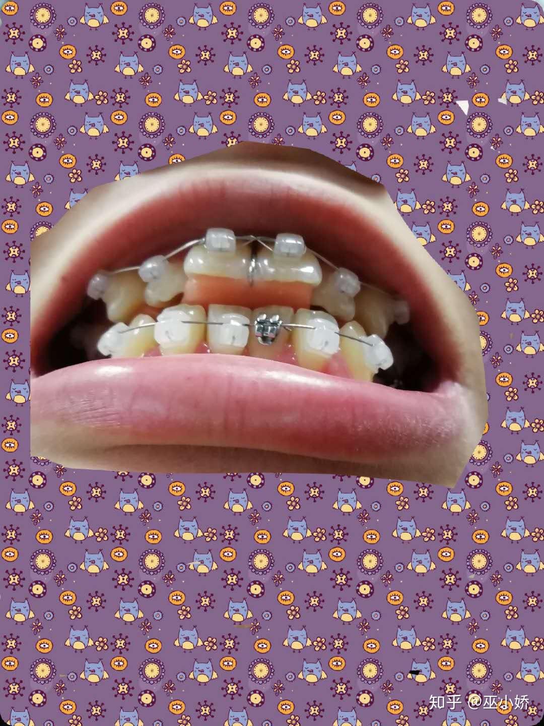 梦境的隐喻,解析梦见左边上颚掉了一颗门牙并出血的深层含义及祈愿 梦境的隐喻,解析梦见左边上颚掉了一颗门牙并出血的深层含义及祈愿