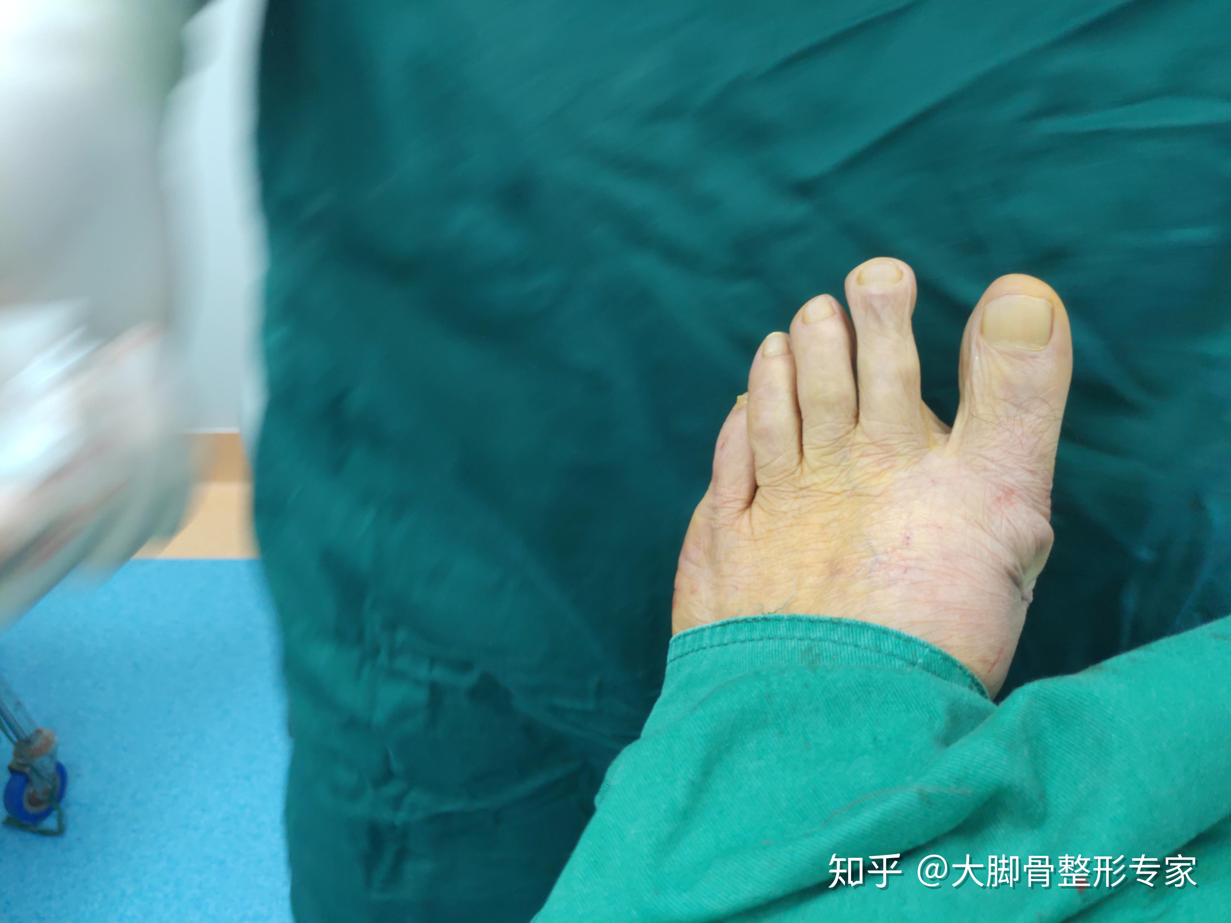 大脚骨要做截骨有点怕可以不用截骨吗