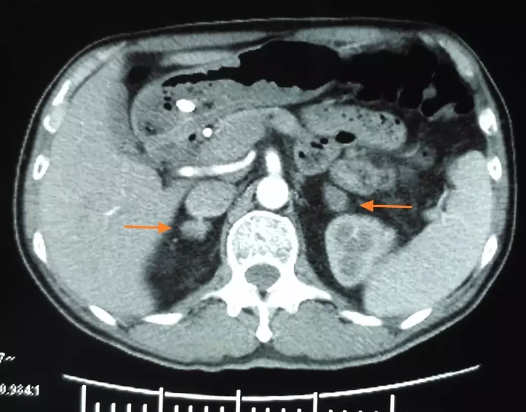 图2:强化ct示双侧肾上腺肿瘤(箭头指向)相关知识点总结及分析:本例