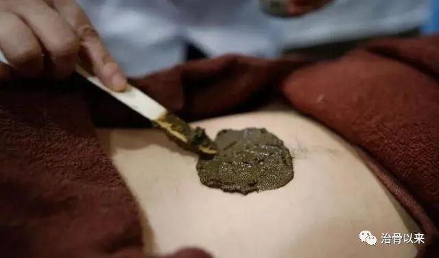 四味中药外敷治腰突分享治腰突的真实外敷验方