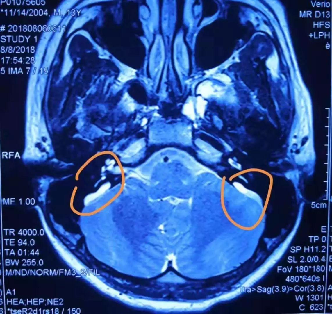 但是,ct或者mri才是诊断前庭导水管扩大的金标准.