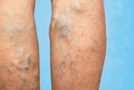 静脉曲张并发症可能致命治疗方式你有这些选择