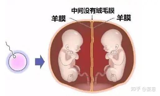 发生率十万分之四,存活率50%的单绒单羊双胞胎