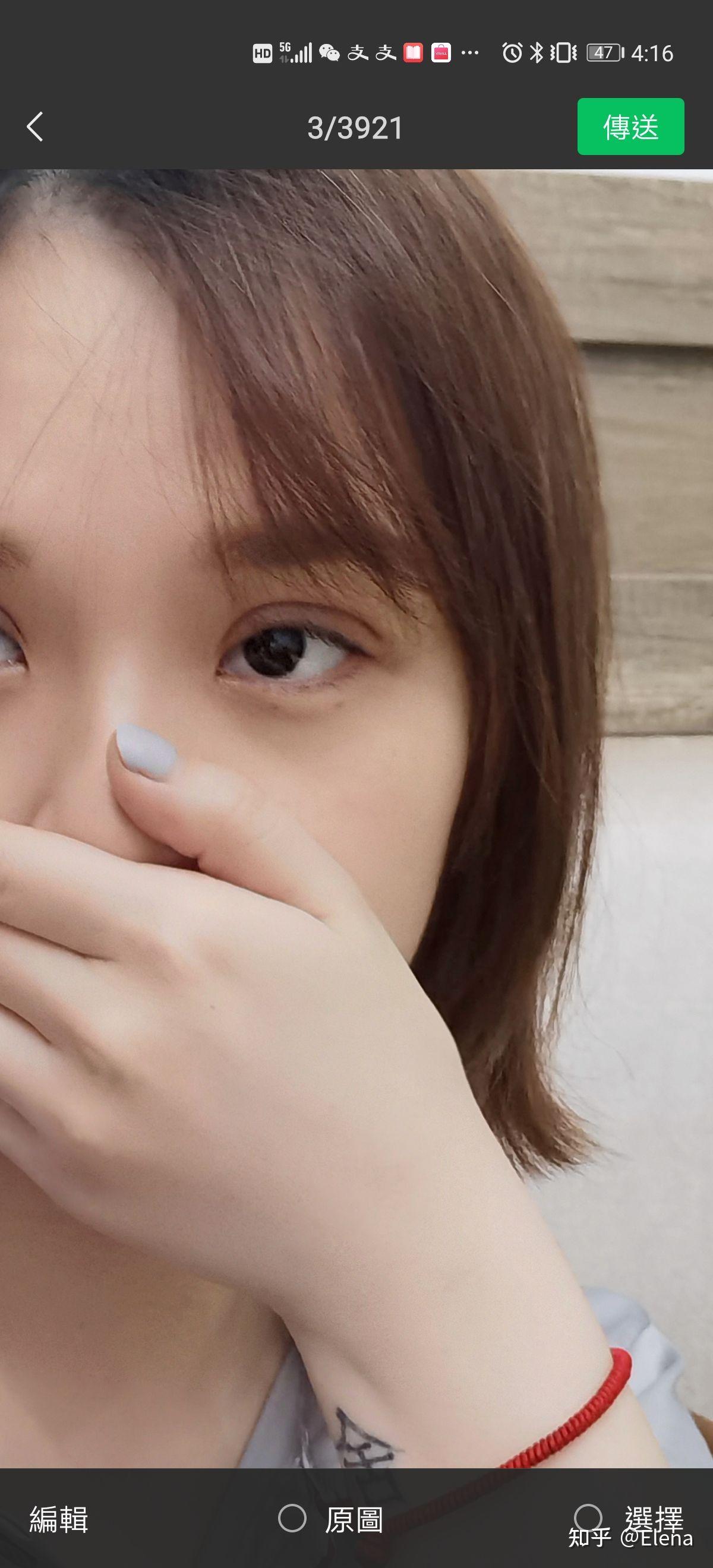 记录一下肿眼泡的埋线双眼皮. - 知乎