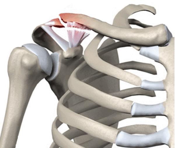 Ⅲ型:锁骨外端完全离开肩峰的相对关节面,为完全脱位.