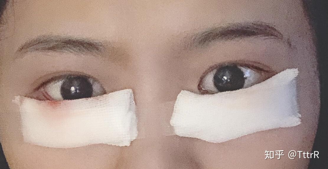 开个倒睫手术的记录吧