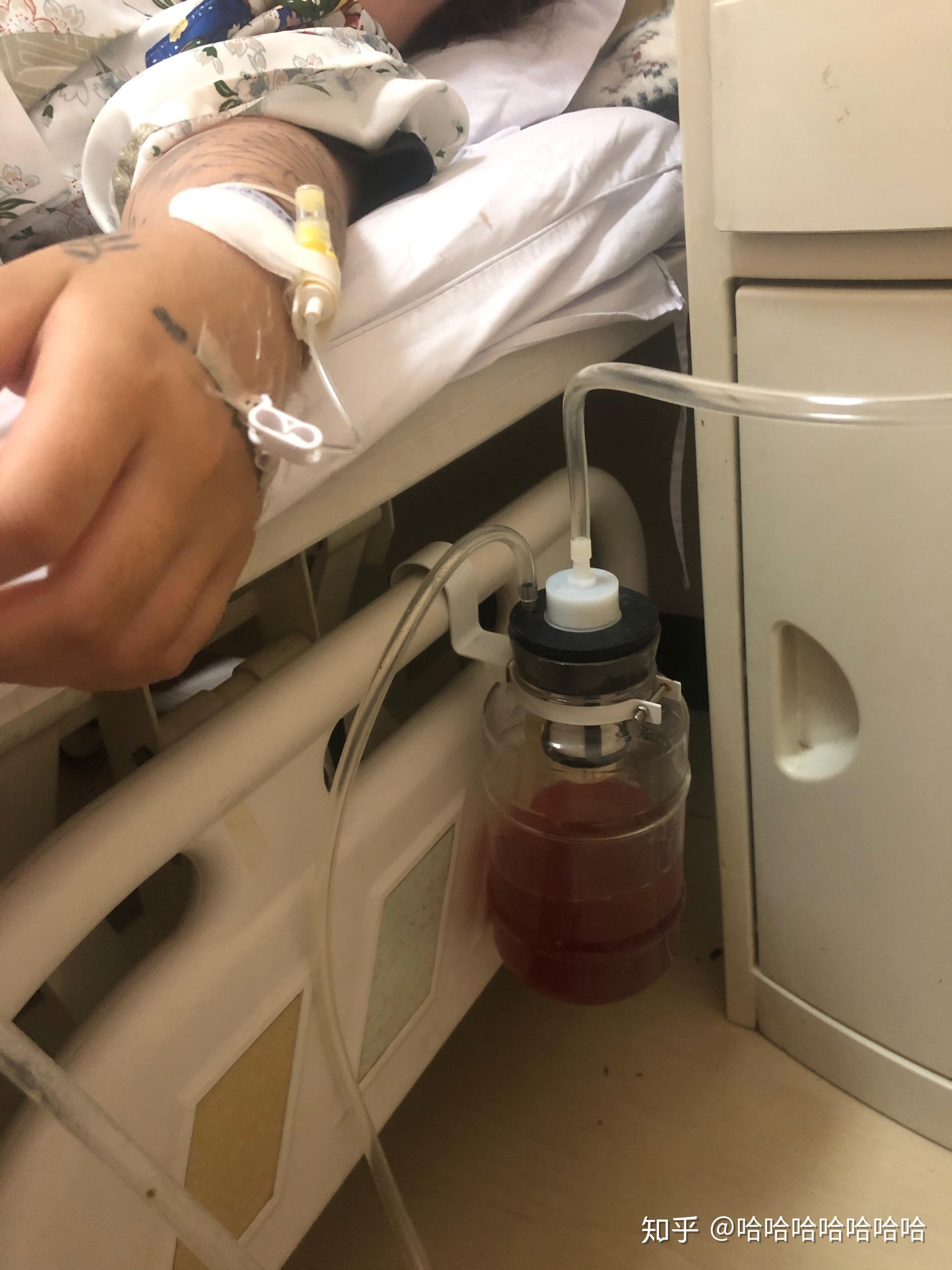 20201016星期五藏毛窦手术完成