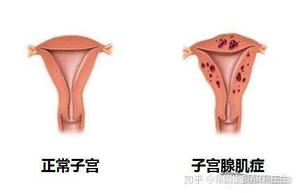 子宫腺肌症伴随卵巢早衰还有救吗