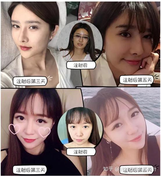 适用于隆鼻,隆下巴,提升眉骨,填充鼻唇沟等部位这款艾莉薇玻尿酸是
