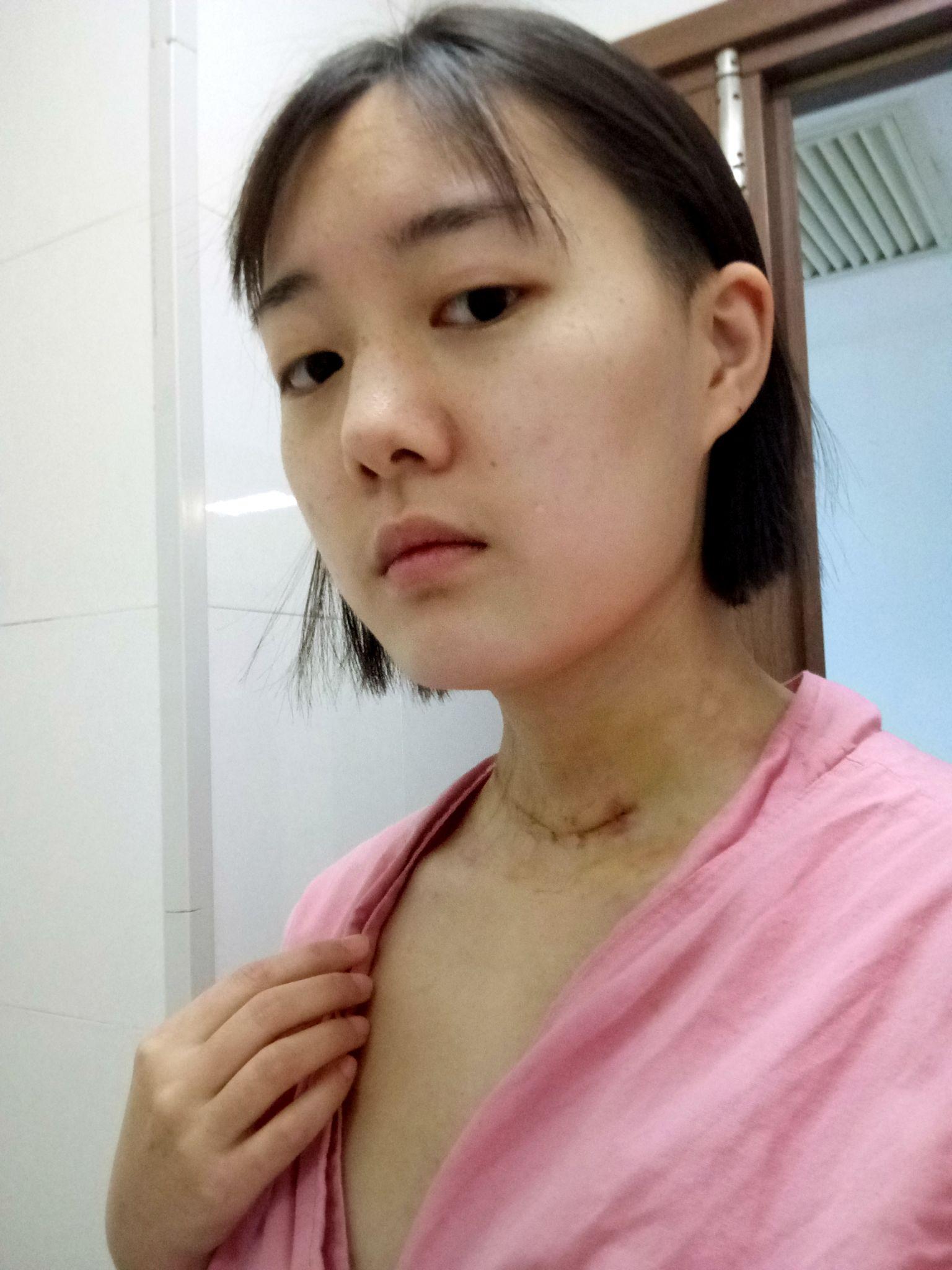 21歲甲狀腺乳頭狀癌患者的真實經歷二