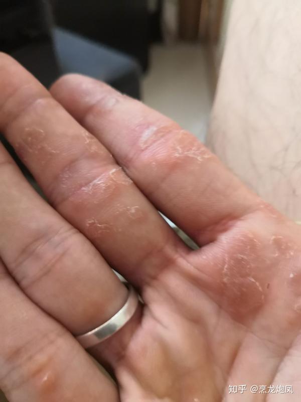 手掌硬皮是什么原因 手掌皮肤角质化增厚 手上长硬皮癣图片