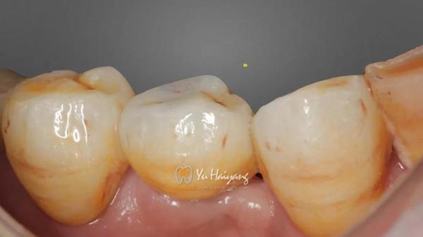 种植一体化氧化锆冠修复单颗后牙缺失1例