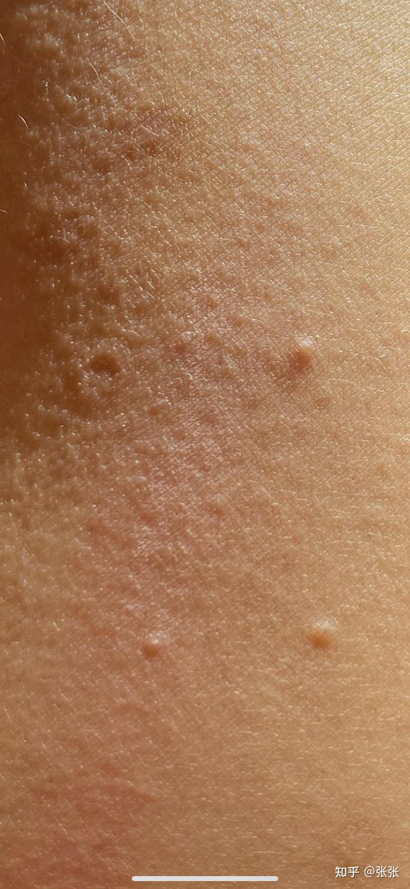 皮肤起芝麻一半大小的肉色的丘疹,抠破变结节性痒疹是为什么