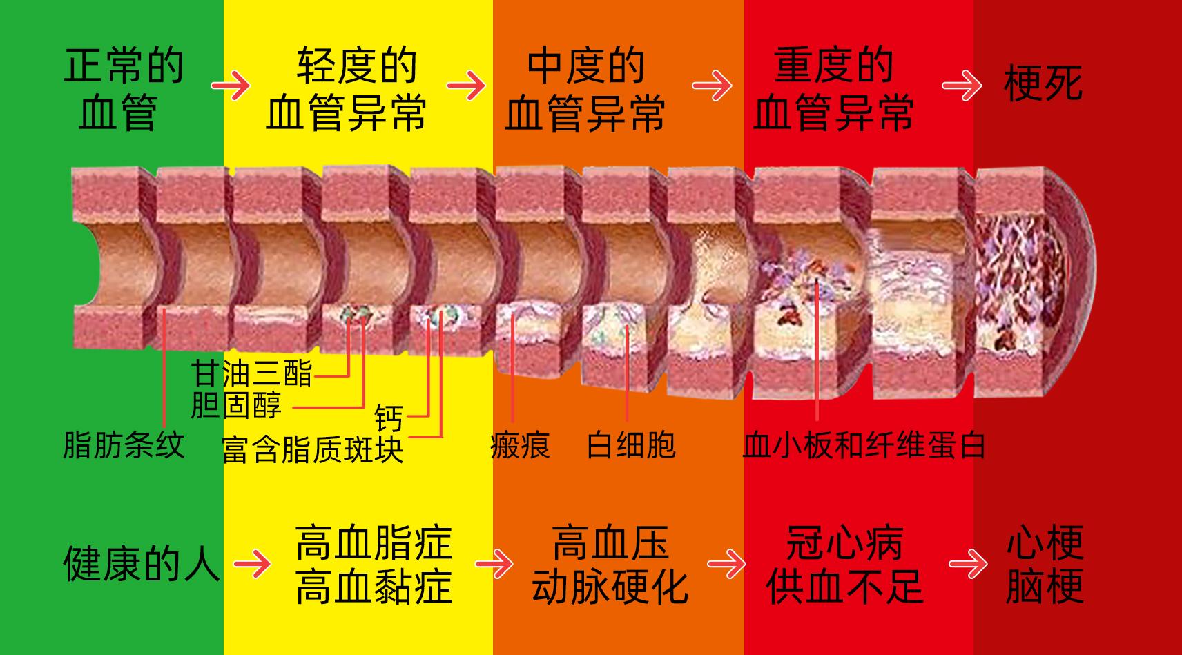 血液粘稠就怕堵了心和脑，只降指标治标不治本！及时清血是关键！ - 知乎