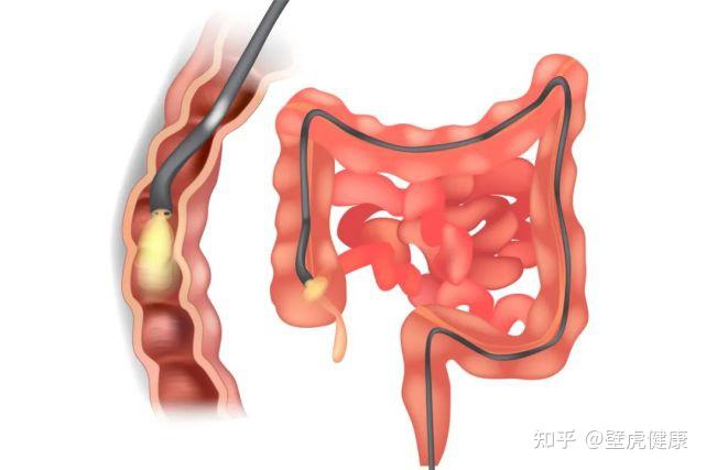 放屁和肠癌,有什么关系?