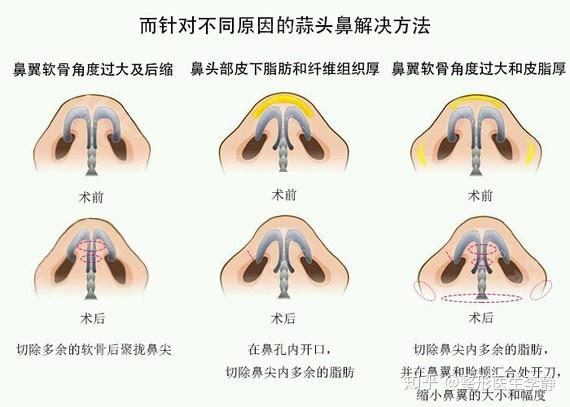 咋样让鼻头变小一点 v2-5fa62682b4a3920706d667ed57647dbb_r.jpg