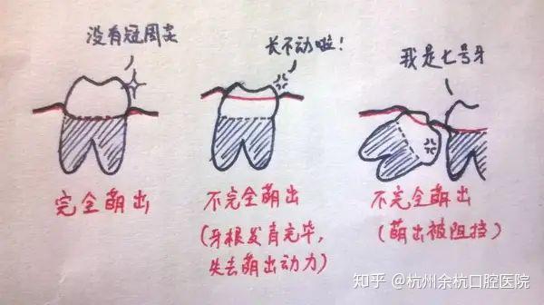 智齿发炎可以直接拔掉吗 知乎