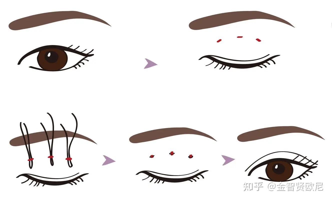 【双眼皮最全攻略】什么类型的双眼皮才适合你?不同术式该怎么选择?(全文干货) - 知乎