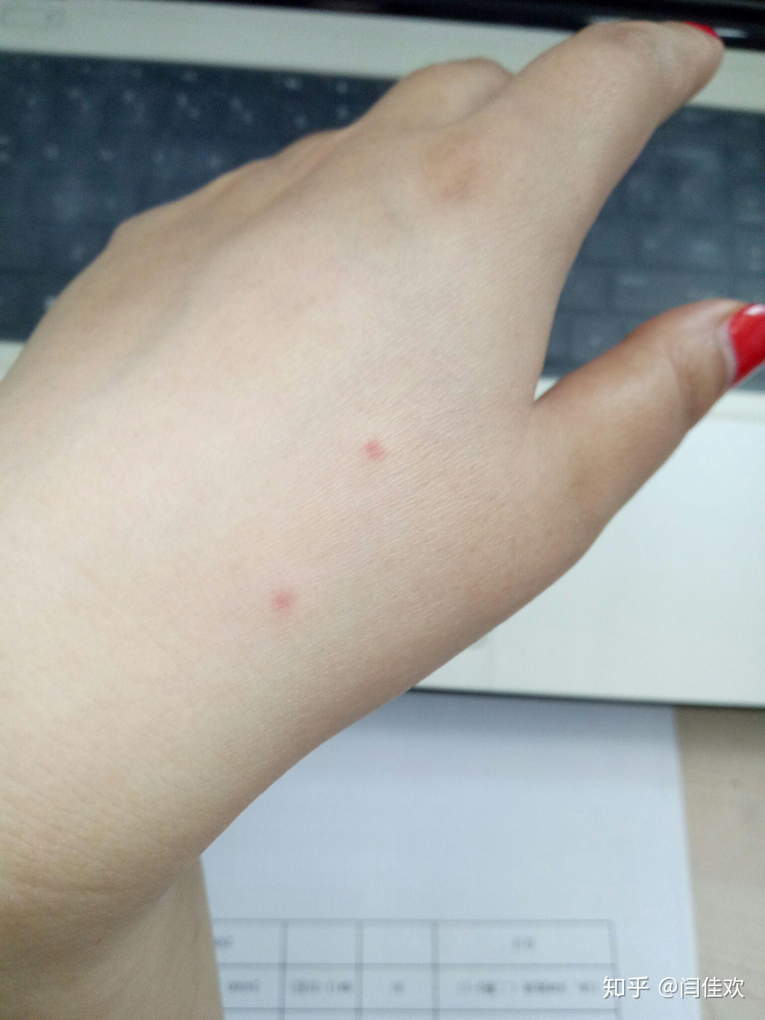 蚊子咬小红点图片
