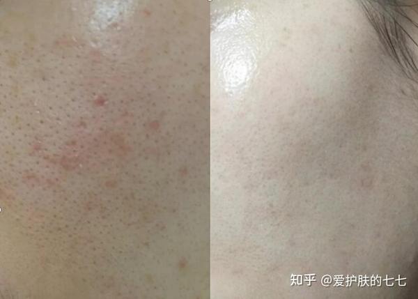 【拯救毛孔粗大】脸粗糙得像砂纸,毛孔密密麻麻,有没有啥靠谱的缩毛孔方法?皮肤科医生教你4步,让皮肤滑滑嫩嫩! - 知乎