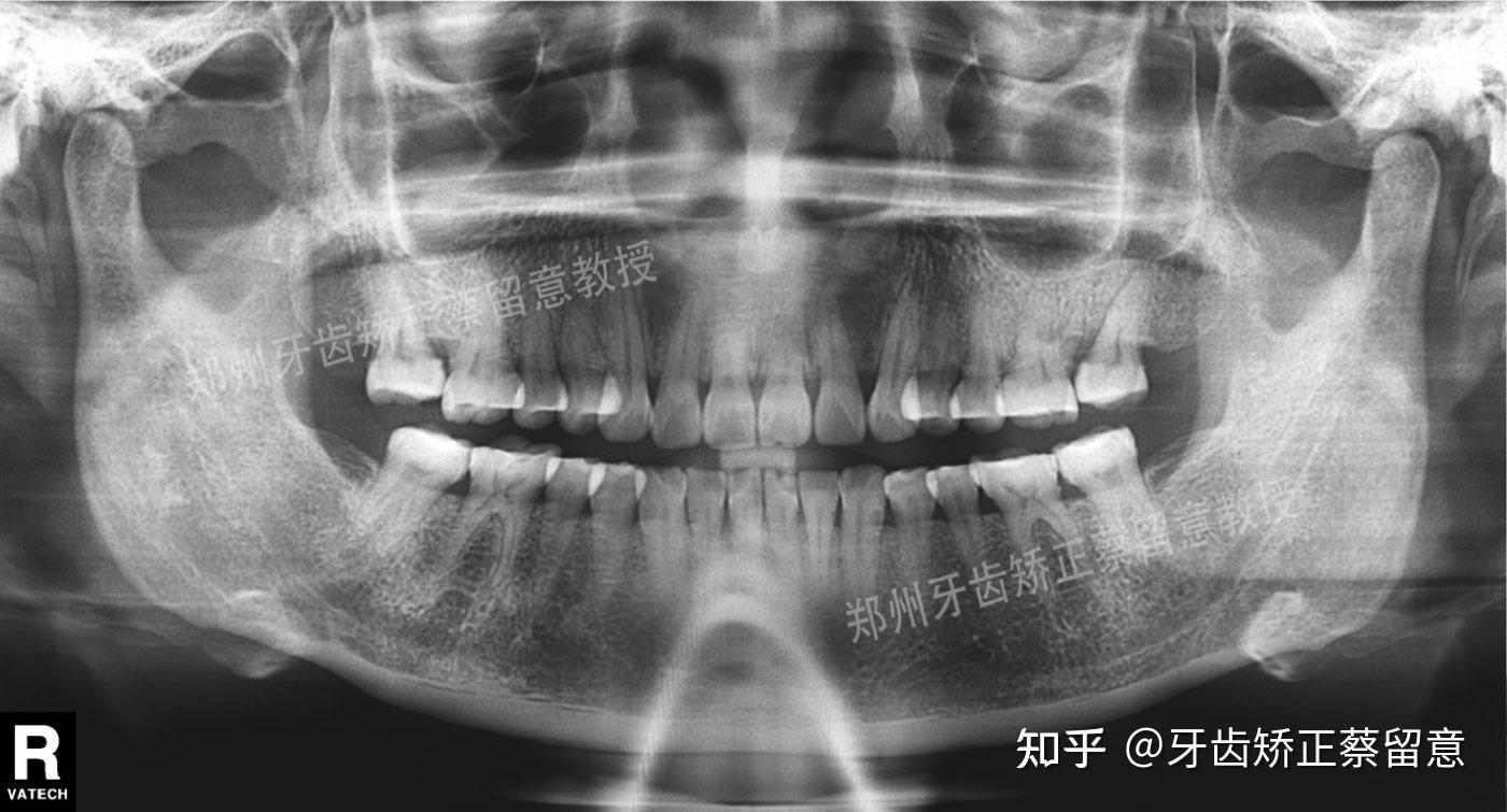 鄭州牙齒矯正個性化舌側矯正骨性疑難正畸病例的優選解決的方式