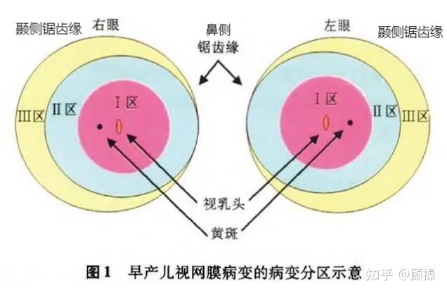 早产儿一定要查眼底