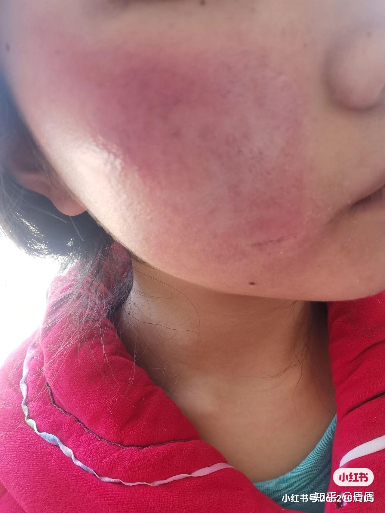 激素脸敏感肌修复的漫长道路