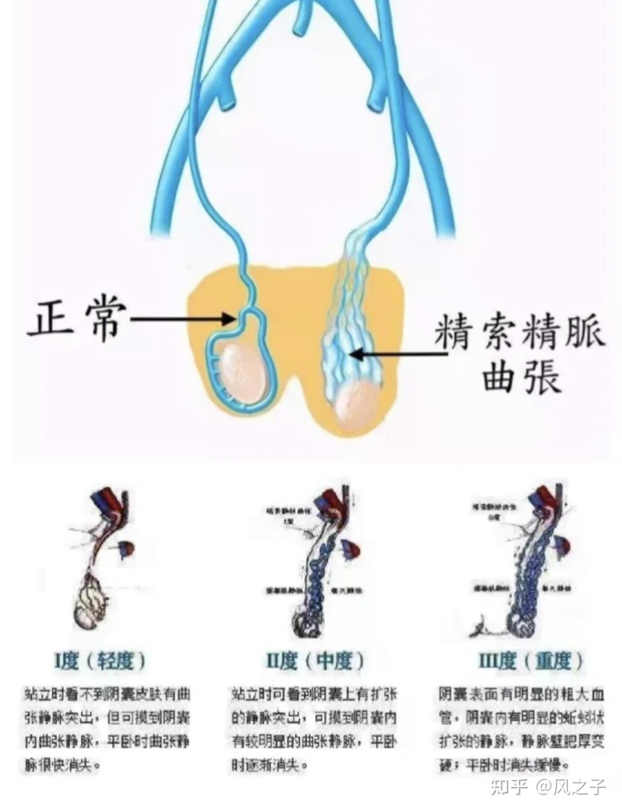 什麼是精索靜脈曲張