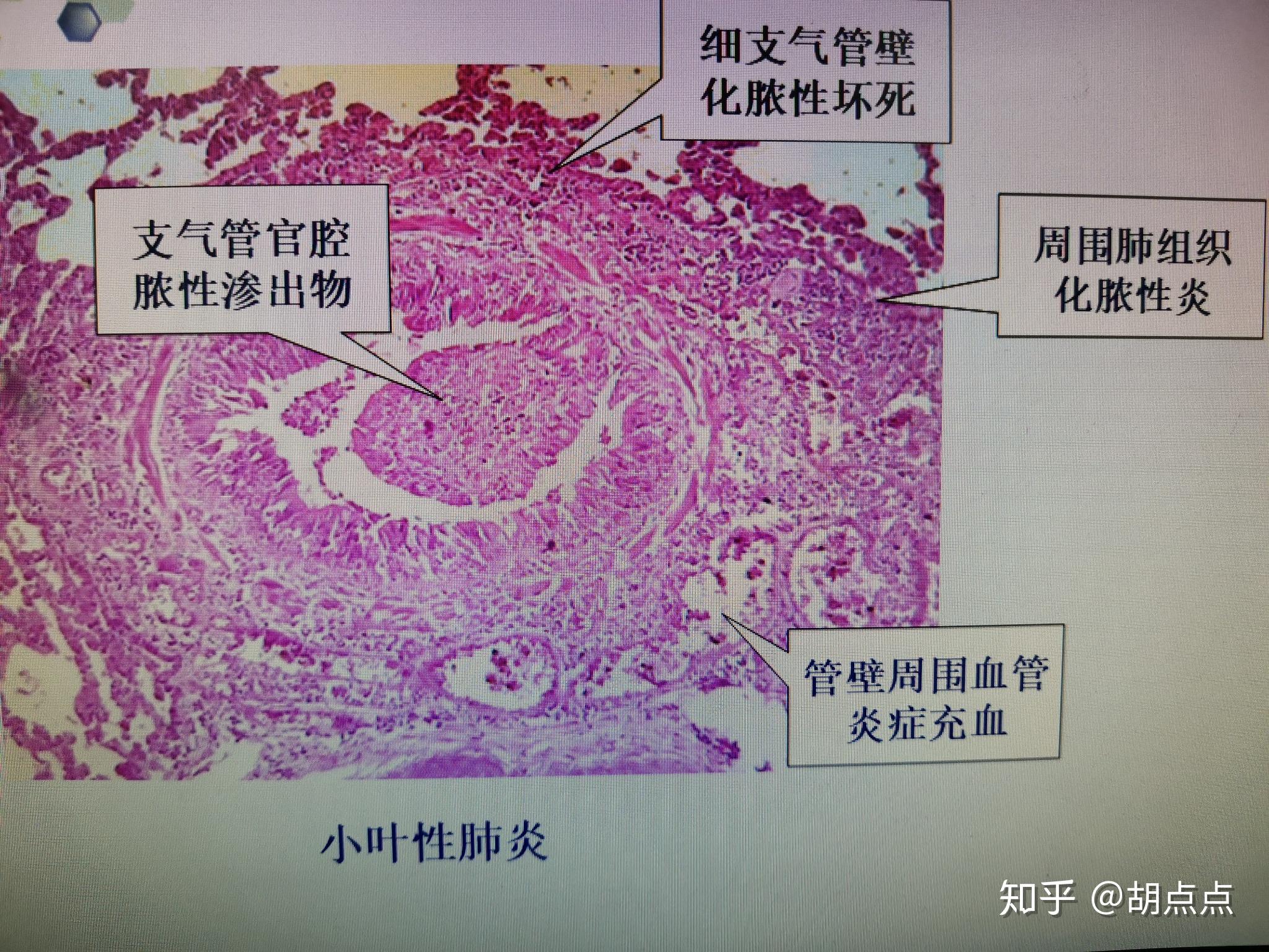 正常肺组织病理切片图图片
