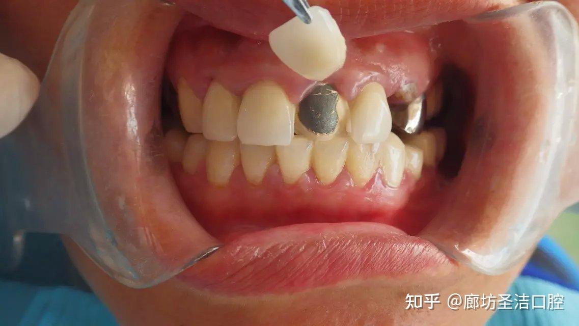 廊坊烤瓷牙掉了一小块,崩瓷了,怎么办?