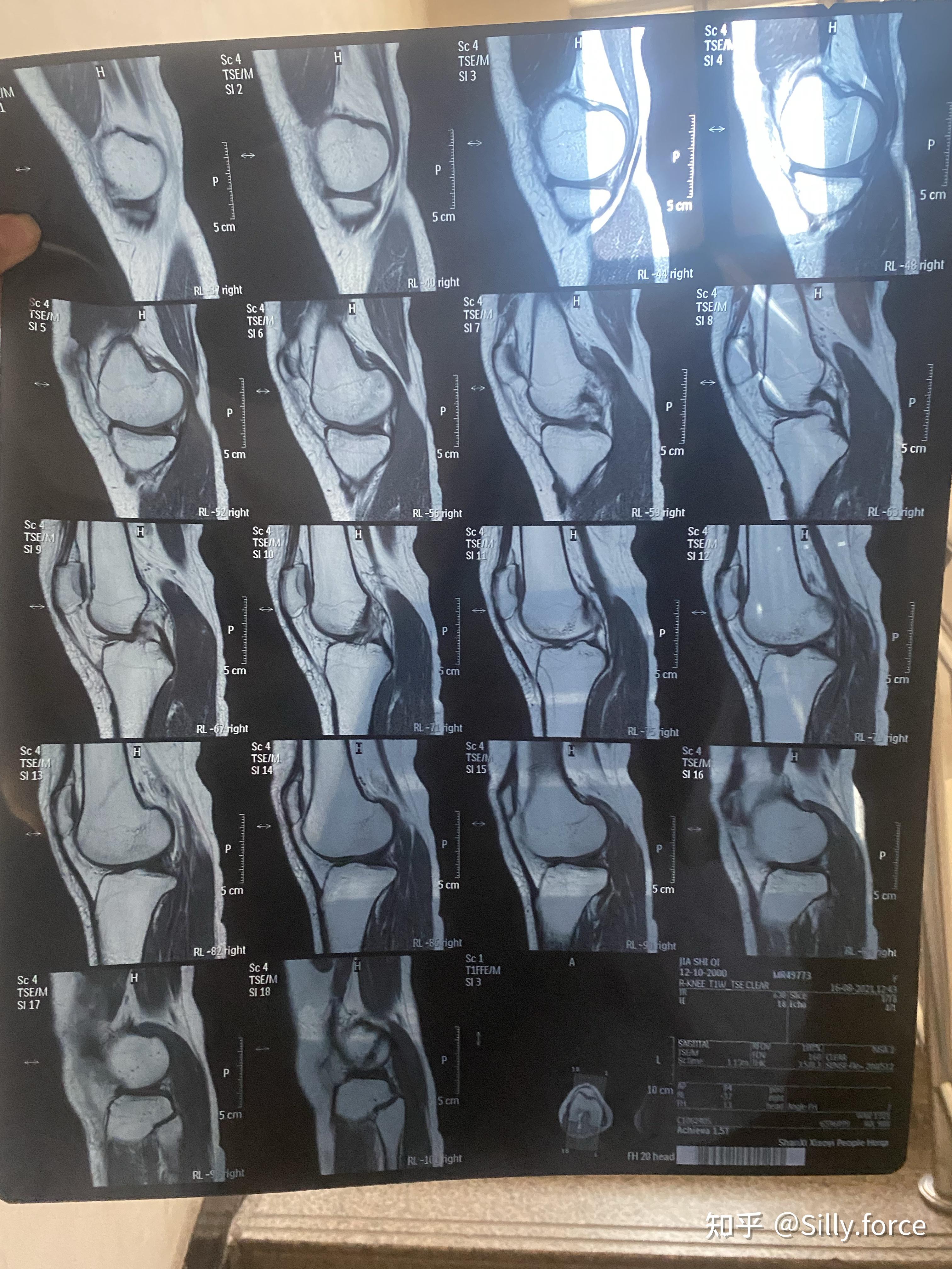 半月板损伤症状图片图片
