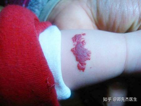 治疗不见效?血管瘤治疗误区你中枪了吗?