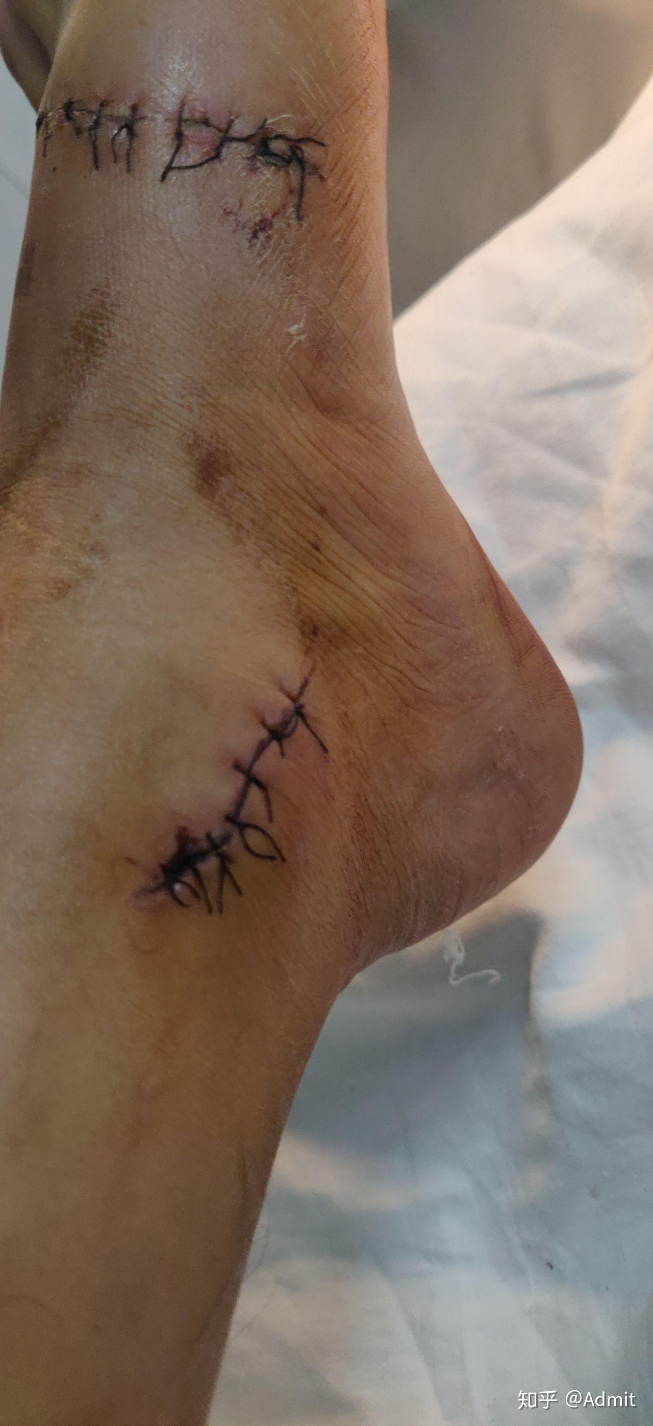 大拇脚趾跟腱断了接好以后不会上翘是什么原因