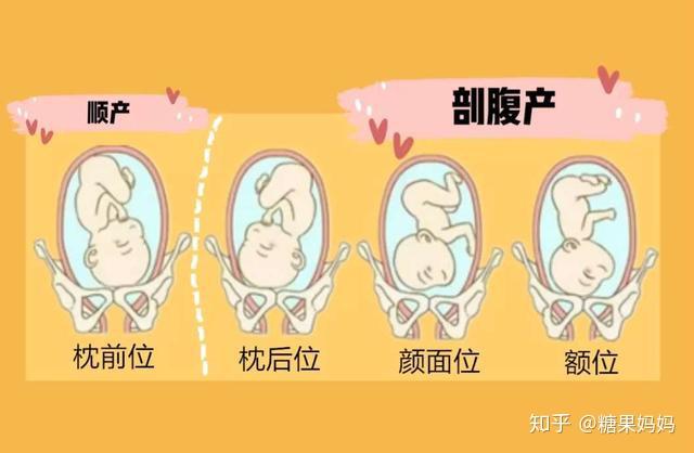 孕妈很辛苦?不,“倒立”的胎儿更辛苦,为什么宝宝要大头朝下? - 知乎