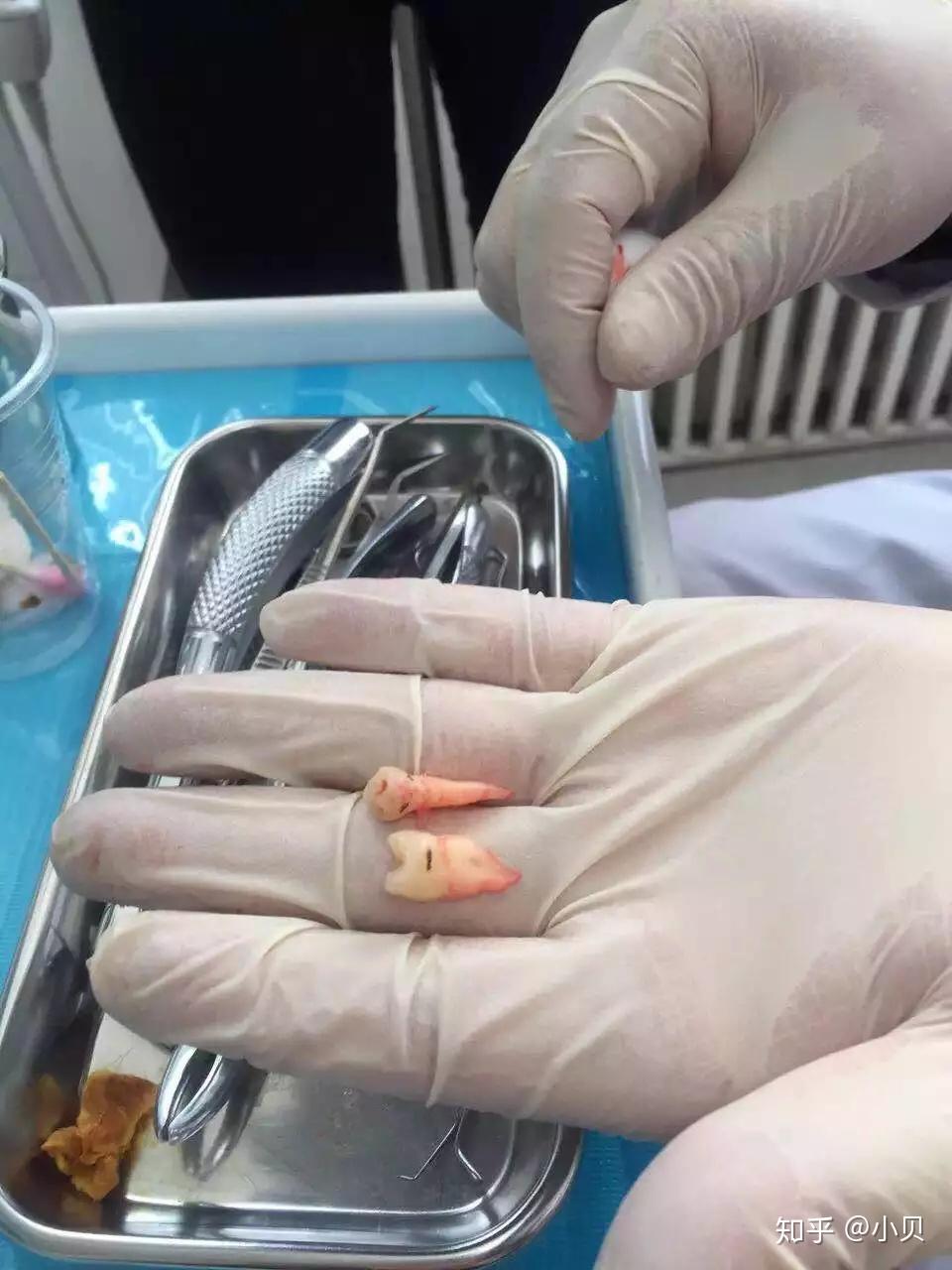 最后拔的牙送给她了,让她没事的时候磨着玩.