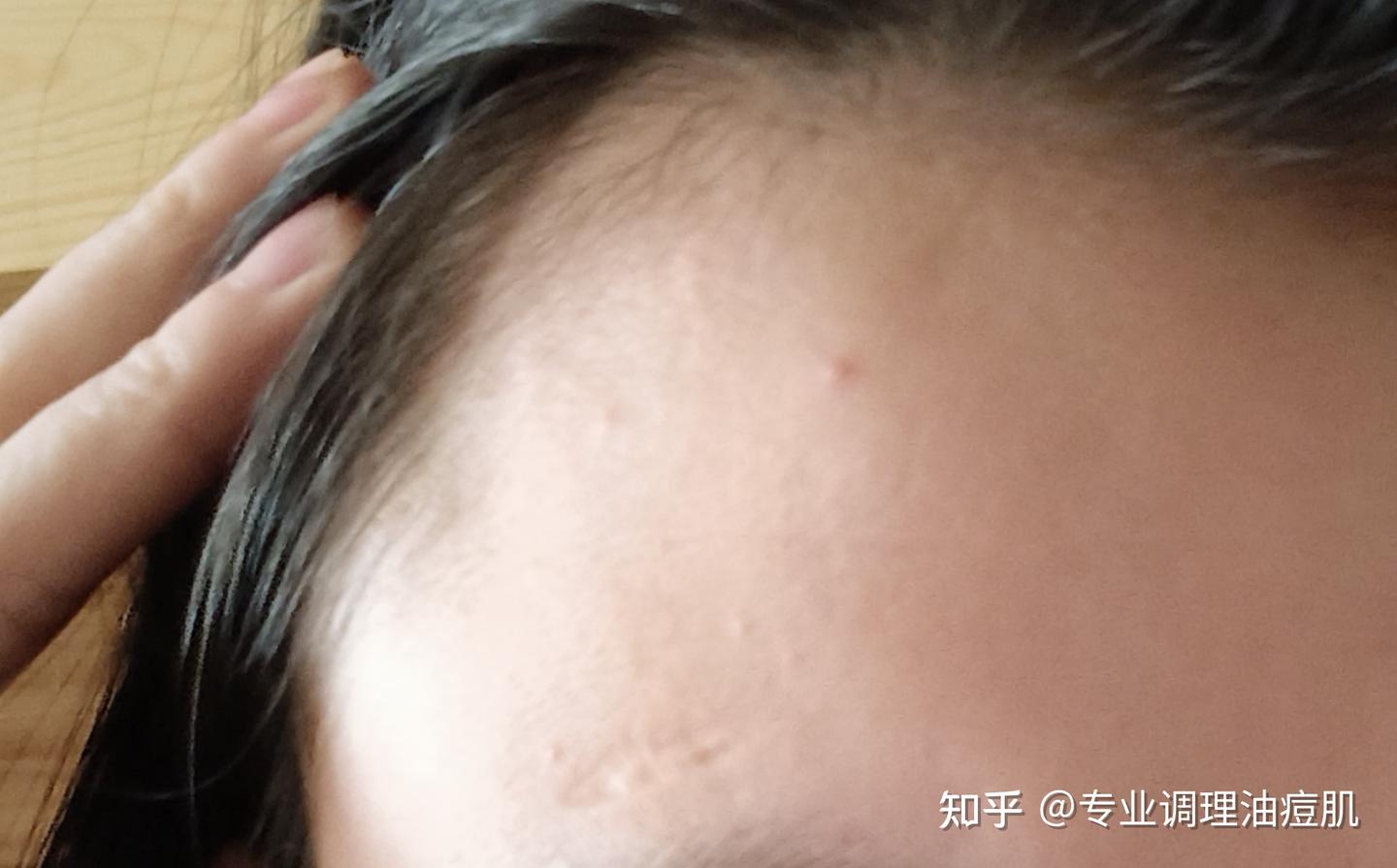 知乎05-天生敏感肌，下巴额头反复闭口的调理之路。 - 知乎